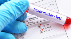 1500 din za tumor markere za debelo crevo u poliklinici Labomedica!