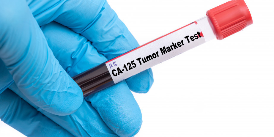  2760 din za analizu tumor markera jajnika u poliklinici Labomedica!