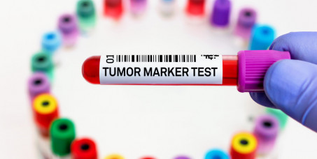 500 din za Tumor marker (PSA) za prostatu sa vađenjem krvi u poliklinici Labomedica!