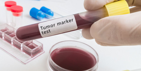 1360 din za Tumor markere (PSA, Free PSA, Index) za prostatu sa vađenjem krvi u poliklinici Labomedica!