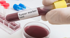 1360 din za Tumor markere (PSA, Free PSA, Index) za prostatu sa vađenjem krvi u poliklinici Labomedica!