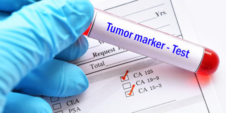 1500 din za tumor markere za debelo crevo u poliklinici Labomedica!