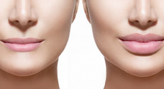 8000 din za popunjavanje usana,jagodica ili bora sa 0,5ml Neauvia filera u ordinaciji BV Dental estetic u Beogradu na vodi!