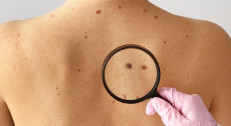 15000 din za hirurško uklanjanje mladeža,ateroma ,lipoma, hidroma,keratoza,fibromi,ksantelazme do 2cm u luksuznoj ordinaciji HOLIMED ESTETIK u Beogradu na vodi! Uklanjanje radi plastični hirurg!