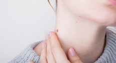 4900 din za radiotalasno uklanjanje papiloma,fibroma sa jedne regije po izboru: vrata, dekoltea,pazuha ili leđa u ordinaciji dr Milena Džuverović na Košutnjaku!