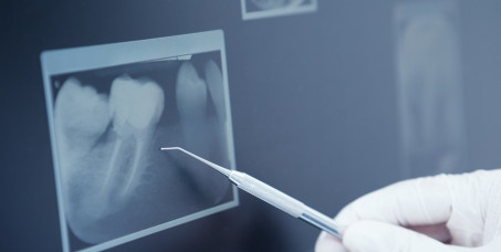 350 din za intraoralni snimak zuba u ordinaciji Pejović Dental!
