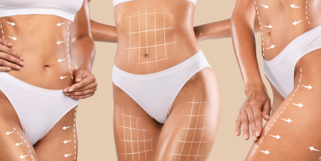 2000 din za Ultra Slim anticelulit paket u ordinaciji Leona life na Novom Beogradu!