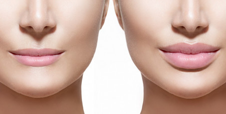 8000 din za popunjavanje usana,jagodica ili bora sa 0,5ml Neauvia filera u ordinaciji BV Dental estetic u Beogradu na vodi!