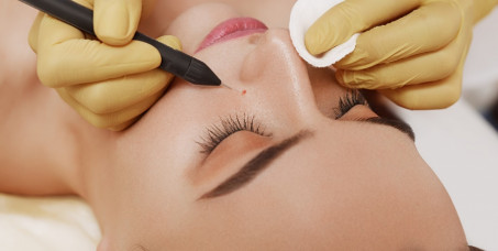 2500 din za uklanjanje do 10 virusnih bradavica u salonu Ashanti beauty na Voždovcu!