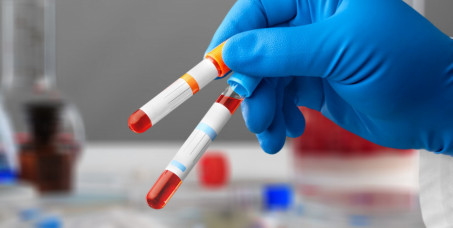 1000 din za biohemijsku analizu krvi( glukoza,kompletni lipidogram,urea,kreatinin,gvožđe,bilirubin,ast,alt,ggt)u poliklinici Labomedica!