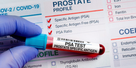 1800 din za tumor markere (PSA, Free PSA, Index) za prostatu sa vađenjem krvi u poliklinici Labomedica!