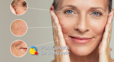 5000 din za tretman CO2 frakcionisanim laserom za uklanjanje bora u poliklinici Dr Rončević!
