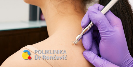 3000 din za lasersko uklanjanje kožnih promena (do 5 manjih ili 1 veća) u poliklinici Dr Rončević!