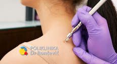 3000 din za lasersko uklanjanje kožnih promena (do 5 manjih ili 1 veća) u poliklinici Dr Rončević!