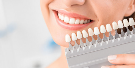 6000 din za ordinacijsko beljenje zuba sa White smile gelom (3*nanošenje po 15 min)+gratis ultrazvučno uklanjanje kamenca i poliranje zuba-Duo Estetica-kod Beogradske Arene!