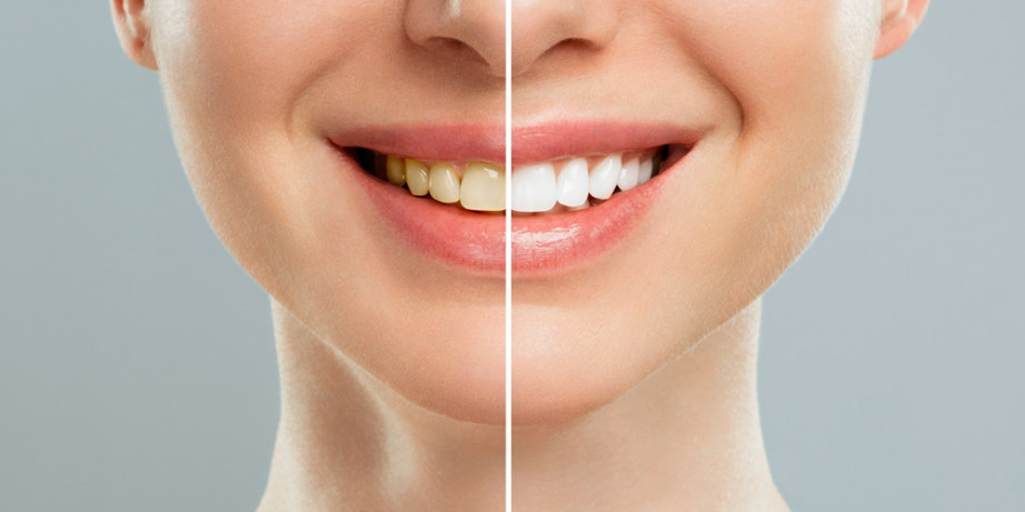 8400 din za izbeljivanje zuba (uzimanje otiska, pravljenje dve folije i dva šprica izbeljivača) u ordinaciji BB Dental u Vojislava Ilića!
