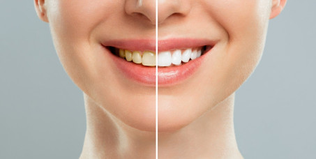 8400 din za izbeljivanje zuba (uzimanje otiska, pravljenje dve folije i dva šprica izbeljivača) u ordinaciji BB Dental u Vojislava Ilića!