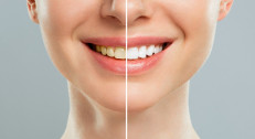 8400 din za izbeljivanje zuba (uzimanje otiska, pravljenje dve folije i dva šprica izbeljivača) u ordinaciji BB Dental u Vojislava Ilića!