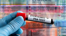 2000 din za tumor markere prostate (tPSA, fPSA ,PSA index) u Zavodu za biocide i medicinsku ekologiju na Banovom brdu!