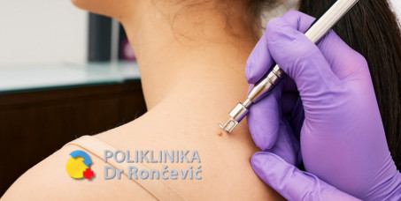 3000 din za lasersko uklanjanje kožnih promena (do 5 manjih ili 1 veća) u poliklinici Dr Rončević!