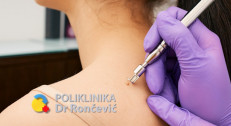 3000 din za lasersko uklanjanje kožnih promena (do 5 manjih ili 1 veća) u poliklinici Dr Rončević!