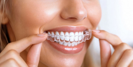 7000 din za izradu dva splinta (ortodontski ritejneri, ili splintovi  za kućno beljenje) u ordinaciji Arenadent na Novom Beogradu!