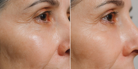 620 din za ostvarivanje popusta na  Age less + Peptide peel tretman lica 45 min u studiju HAPPY LADY za 2500 din!