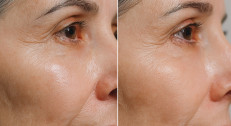620 din za ostvarivanje popusta na  Age less + Peptide peel tretman lica 45 min u studiju HAPPY LADY za 2500 din!