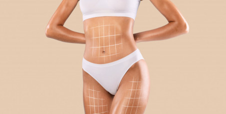 4000 din za lipolizu jedne regije (podbradak, unutrašnjost butine, nadlaktice ili pola stomaka) - SO Trajić - Novi Beograd!