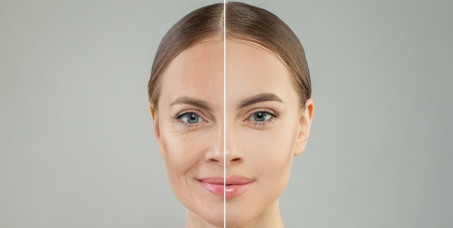 12000 din za 3 x radiotalasni lifting lica (50 min) u salonu Professional beauty and spa u Žarkovu!