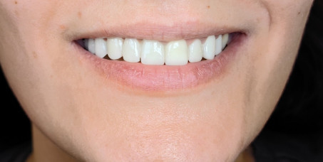 14000 din za bezmetalnu cirkon i privremenu PMMA krunu u MAKS DENTU u Zemunu!