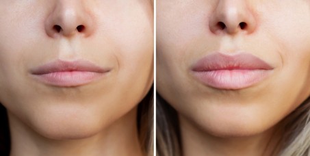 12000 din za hijaluron pen (1 ml) u salonu Professional beauty and spa u Žarkovu!