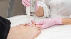 3000 din za lasersko uklanjanje gljivica (1 tretman) u SOLAR MEDICAL CENTRU!